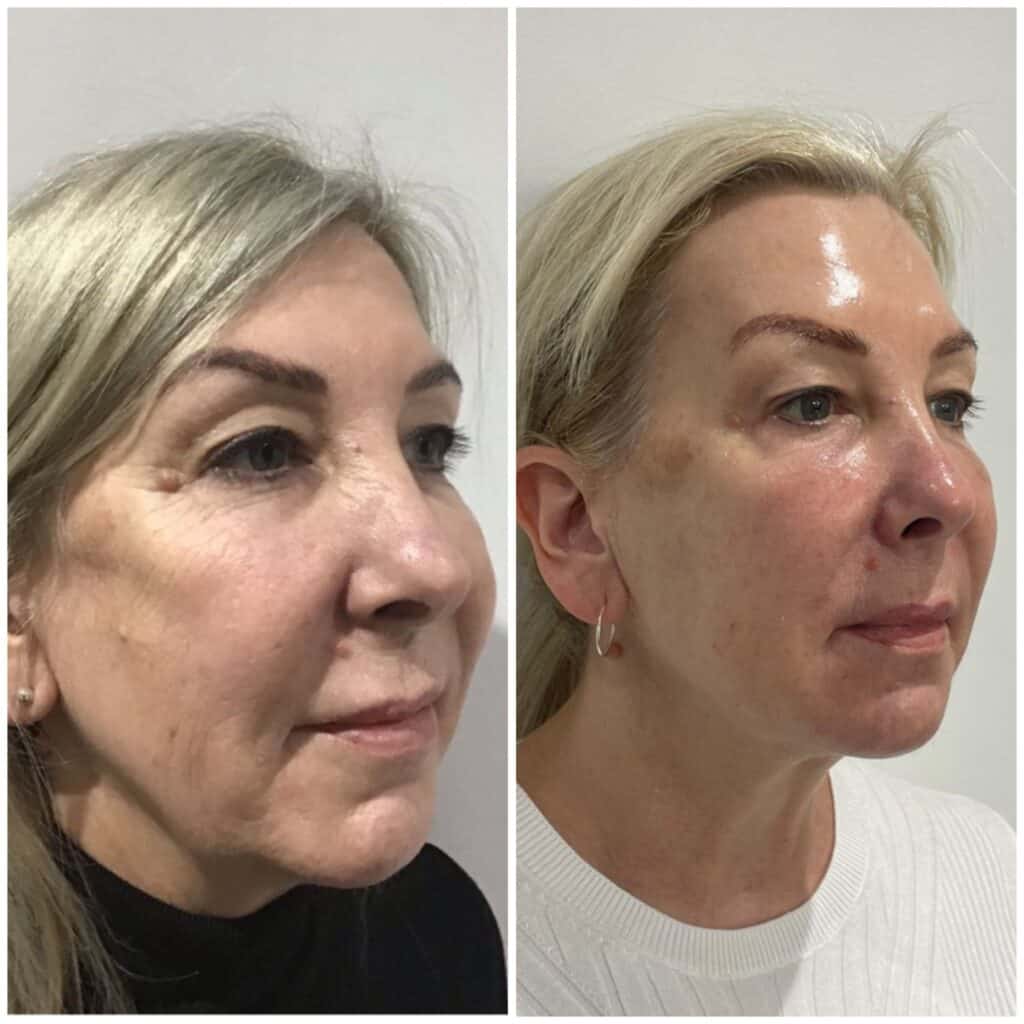 Dr Bailey medspa before and after full face rejuvenation