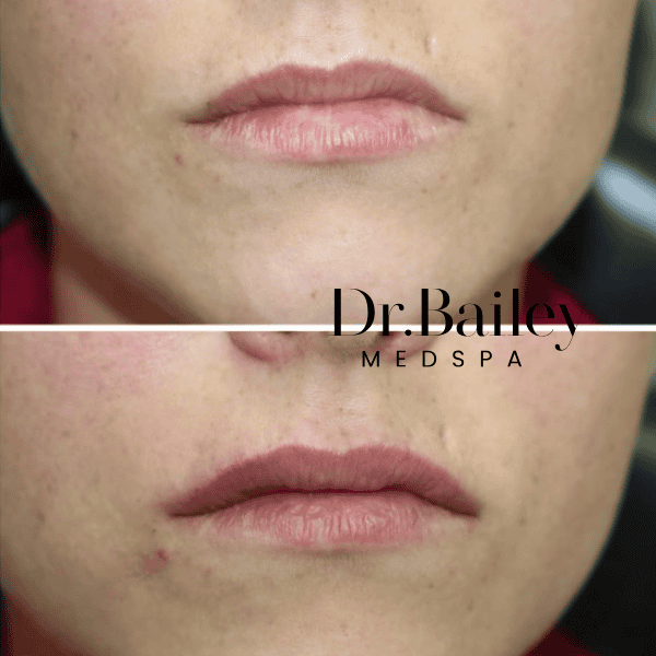 what does half a ml of lip filler look like