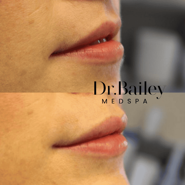 what does 1 ml of lip filler look like before and after