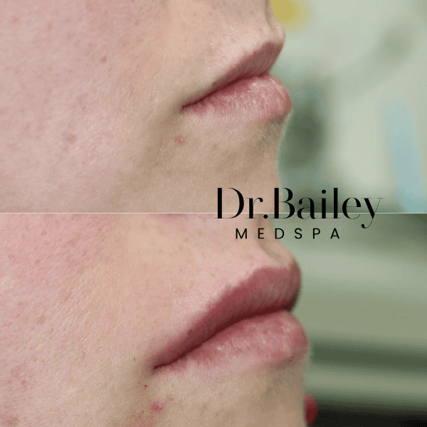 balancing Lip filler before and after Leeds
