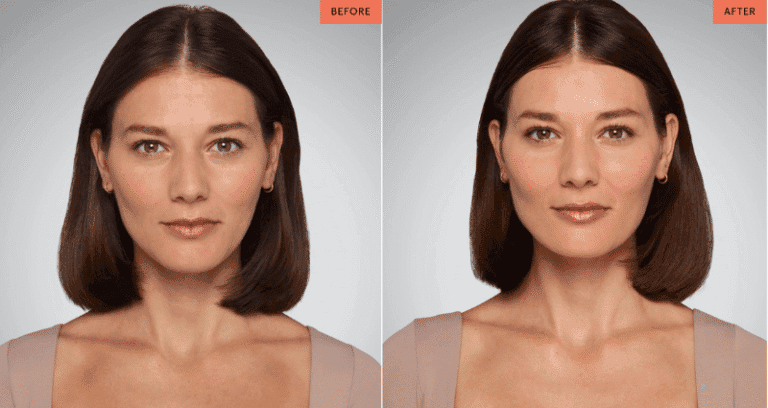 Juvederm lip fillers in Leeds