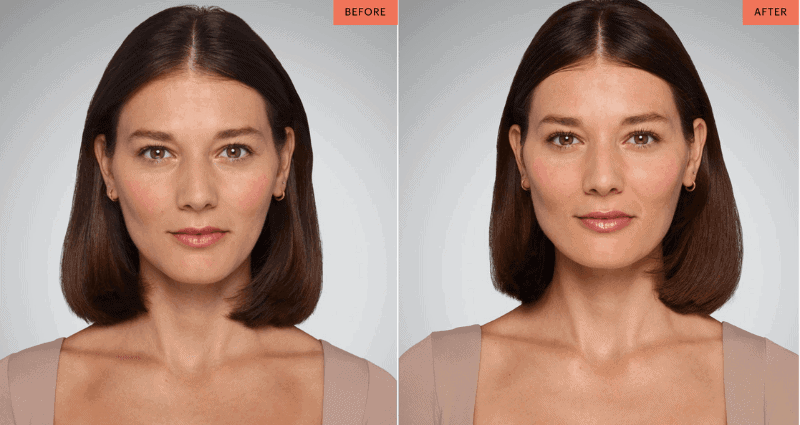 Juvederm lip fillers in Leeds