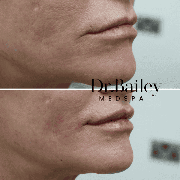 Lip filler before and after Leeds city centre
