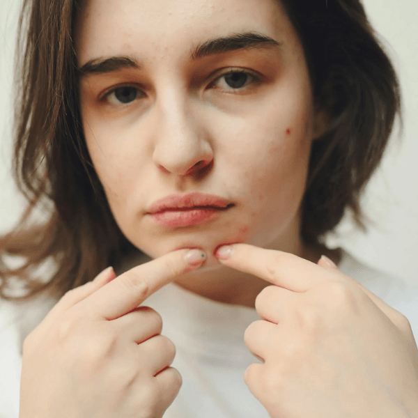 Acne treatment in Leeds