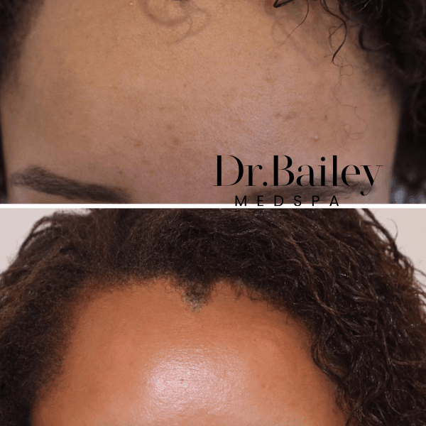 tretinoin before and after dr bailey medspa leeds