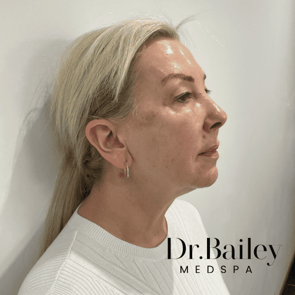 After full face rejuvenation aged 60