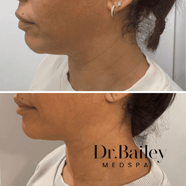 before and after chin filler in leeds