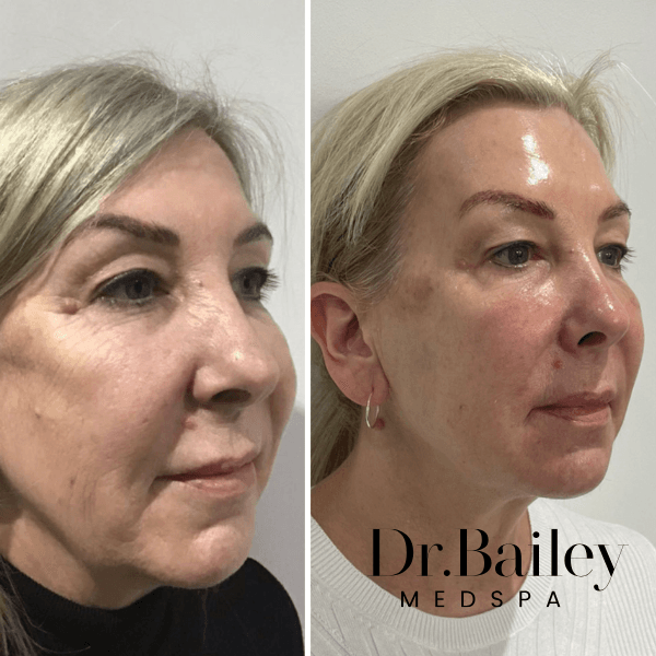 non surgical facelift before and after