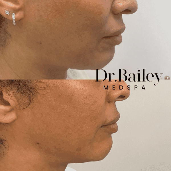 lower face dermal fillers before and after leeds