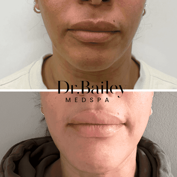before and after jaw and chin filler leeds
