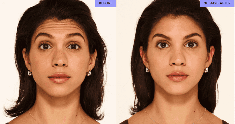 botox at dr bailey medpsa in Leeds