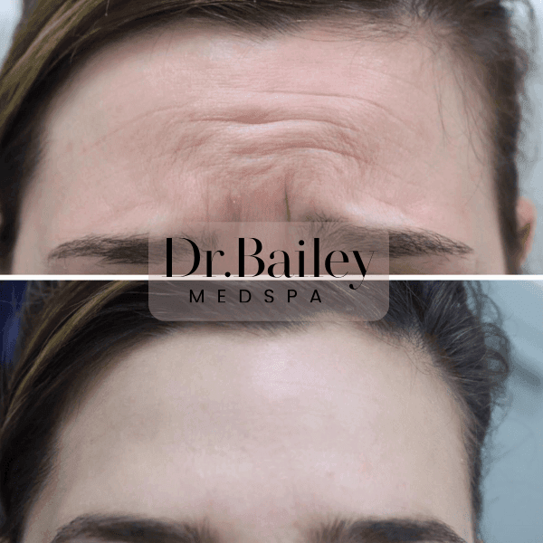 Botox Leeds before and after