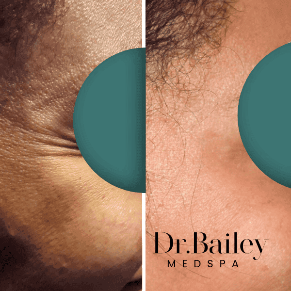 Botox at Dr Bailey medspa Leeds city centre