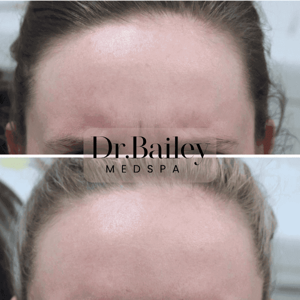 botox before and after eleven lines leeds