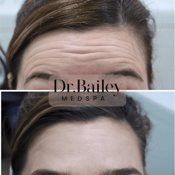 Botox treatment leeds university before and after